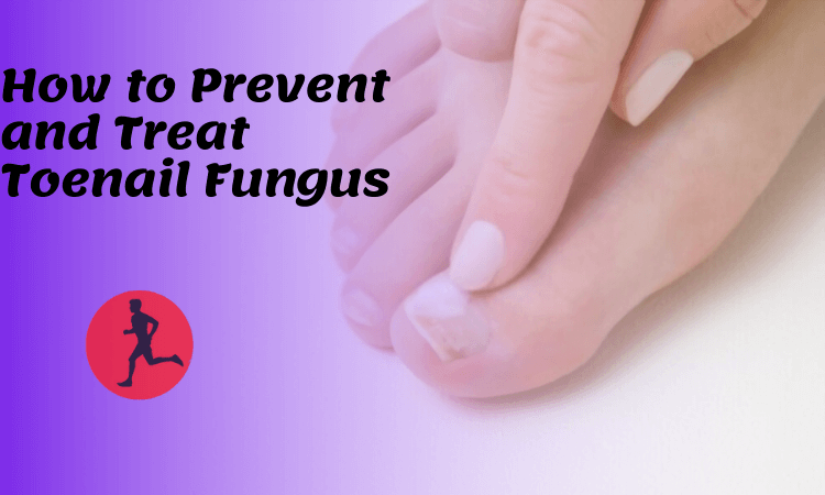 Onychomycosis, often known as toenail fungus, is a slow-growing infection of the nail and the area underlying it.
