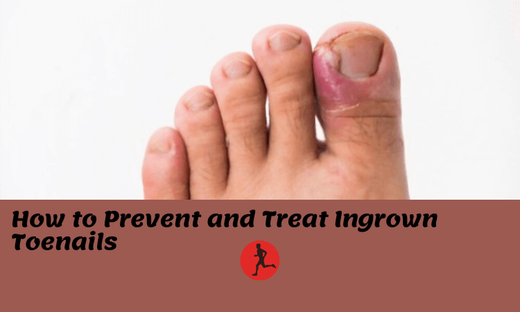 When the edge of a toenail, generally the big toe, grows into the skin adjacent to it, it is termed an ingrown toenail (called the lateral nail fold).
